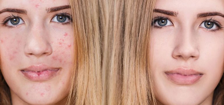 L'acné : un passage obligé ? – Docteur Isabelle Meurgey