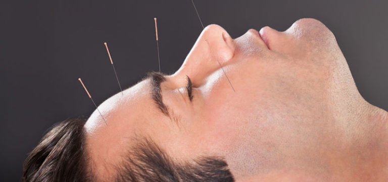 lifting acupuncture