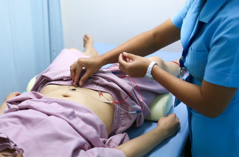 electroacupuncture