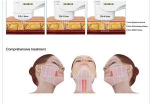 fonctionnement de l'hifu sur le visage et cou