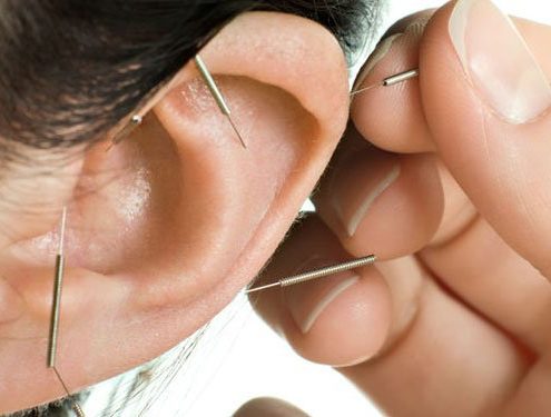 L'auriculotherapie sur l'oreil d'un patient